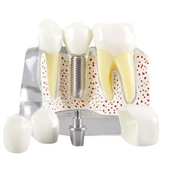 Zuby Demonštrácia Model Implantát Vymeniteľné Analýza Koruny Most -Pacient Komunikácie